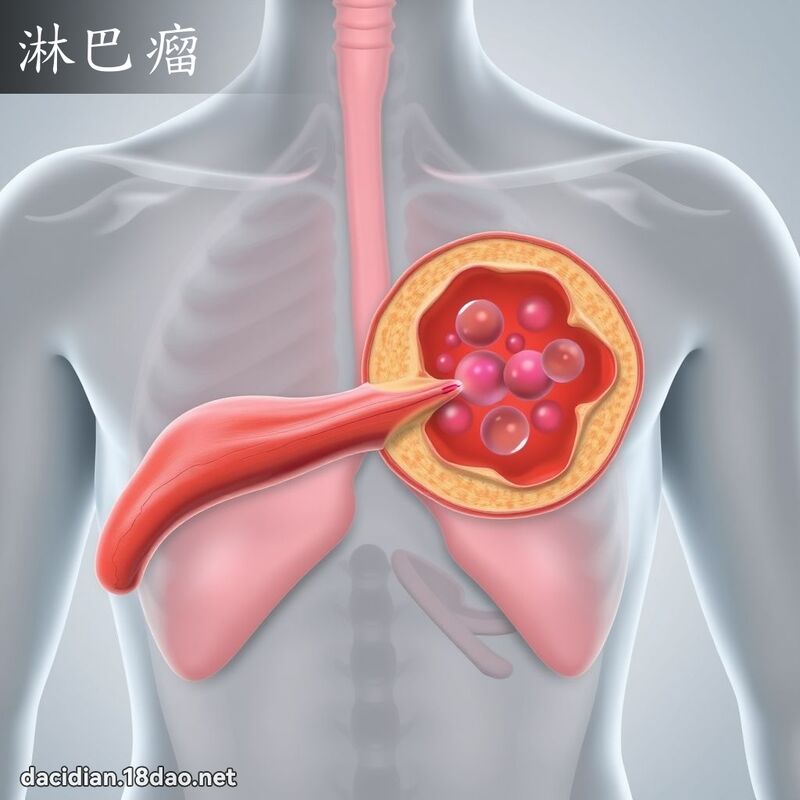 淋巴瘤 - 國語大辭典配圖