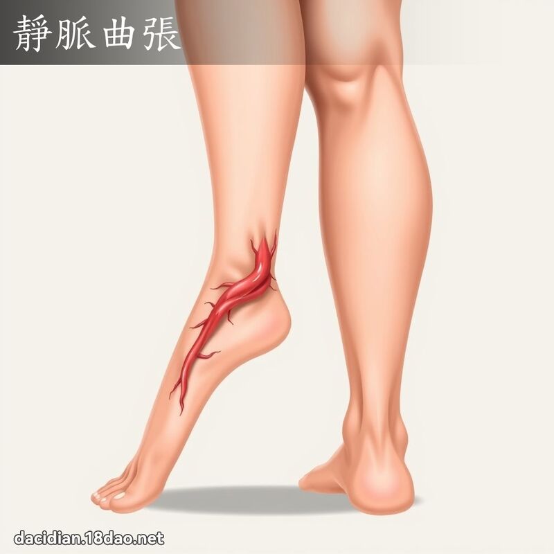靜脈曲張 - 國語大辭典配圖